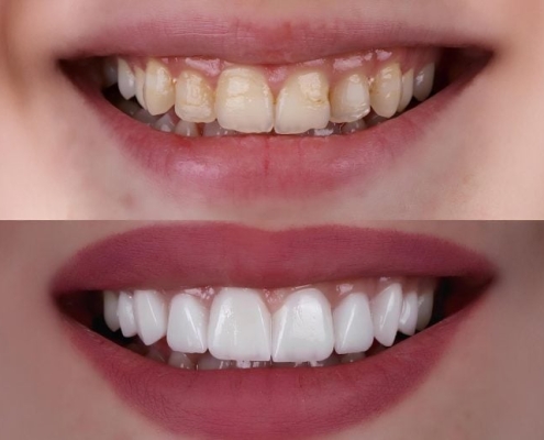 The Crown Jewel of Dentistry? Breakthrough Tech Could Transform Tooth Repair