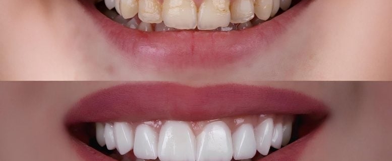 The Crown Jewel of Dentistry? Breakthrough Tech Could Transform Tooth Repair